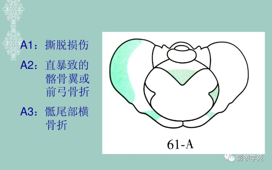 骨盆,髖臼骨折的分型