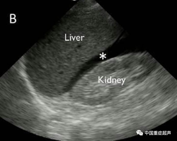 间隙,左肾下极(左结肠旁沟)(7615雪花处为脾周及脾肾隐窝的积液)4
