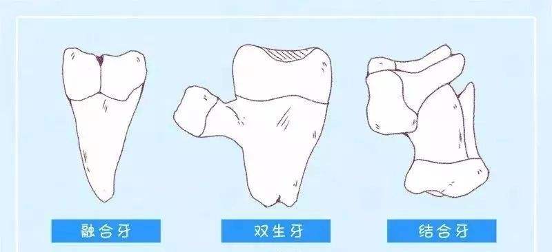 乳牙融合多单侧发生,两颗牙融合多见.
