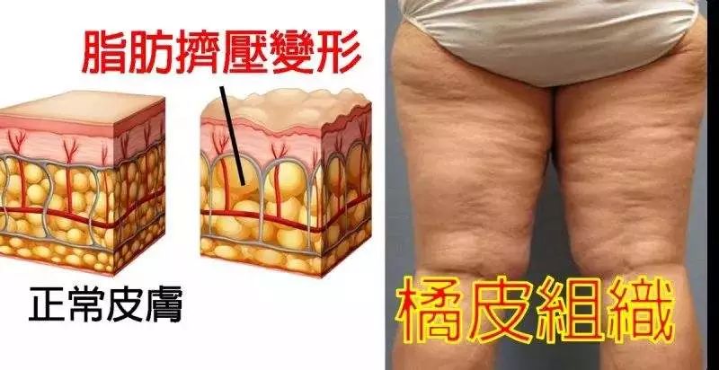 特别像大腿后侧,容易胖到出现橘皮组织,它都能统统解决!