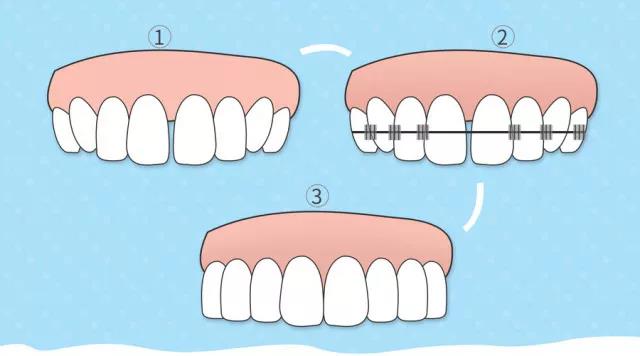 牙齿变长牙缝变宽注意!你的牙龈正在萎缩!