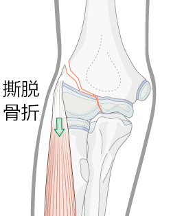 肘关节过伸和外翻区别图片