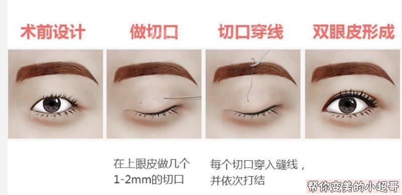 美利莱双眼皮修复最全攻略小超哥带你了解修复背后的故事