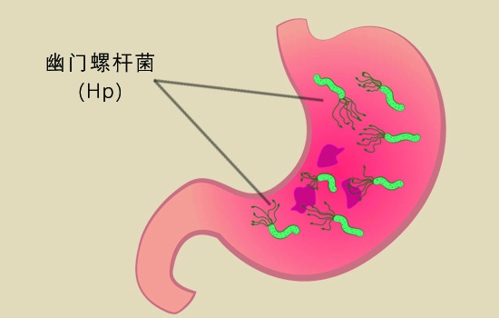 簡單的來說,幽門螺桿菌是目前人類所知能夠在胃中生存的唯一微生物