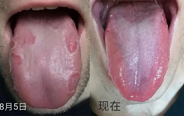 抢号失眠是系统性疾病非一脏一腑所为舌苔剥落或裂纹是身体严重受损的