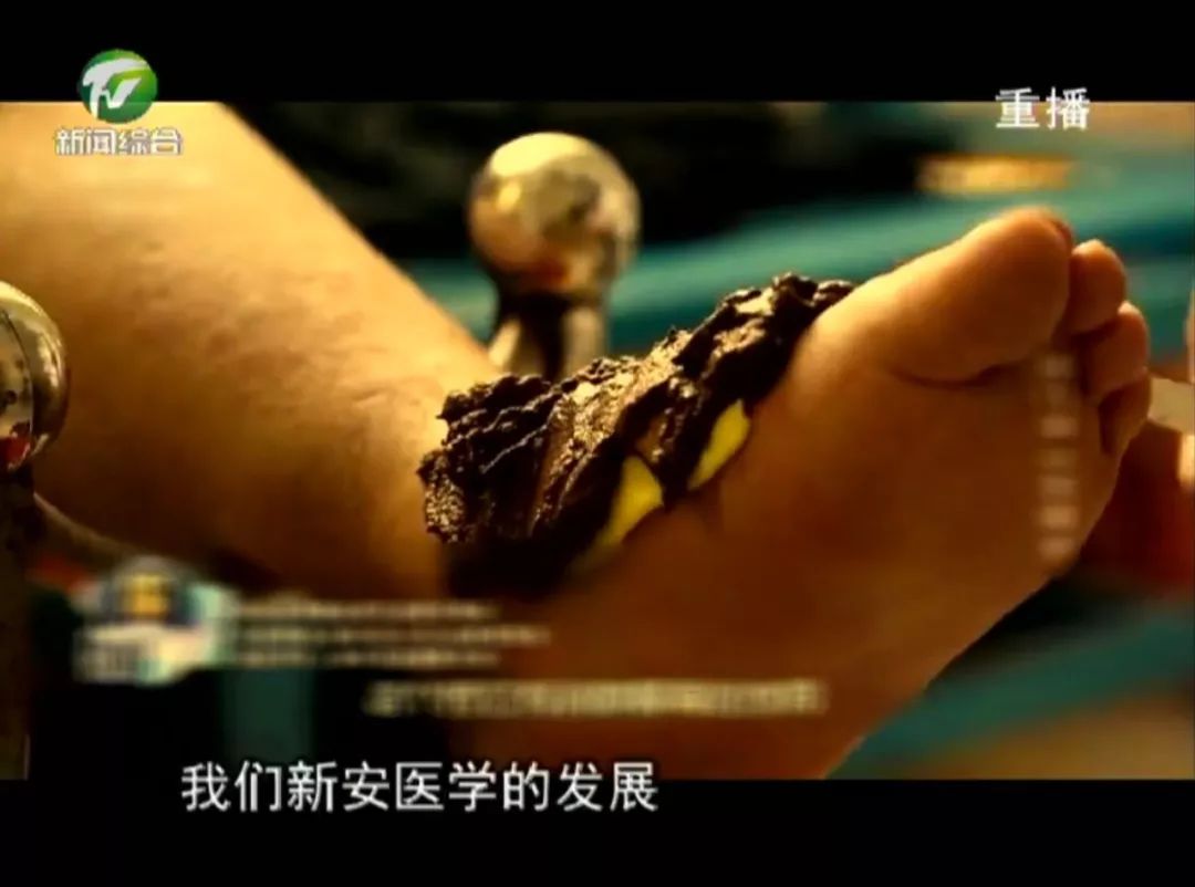 祁门蛇伤研究所救死扶伤创造全国蛇伤救治奇迹