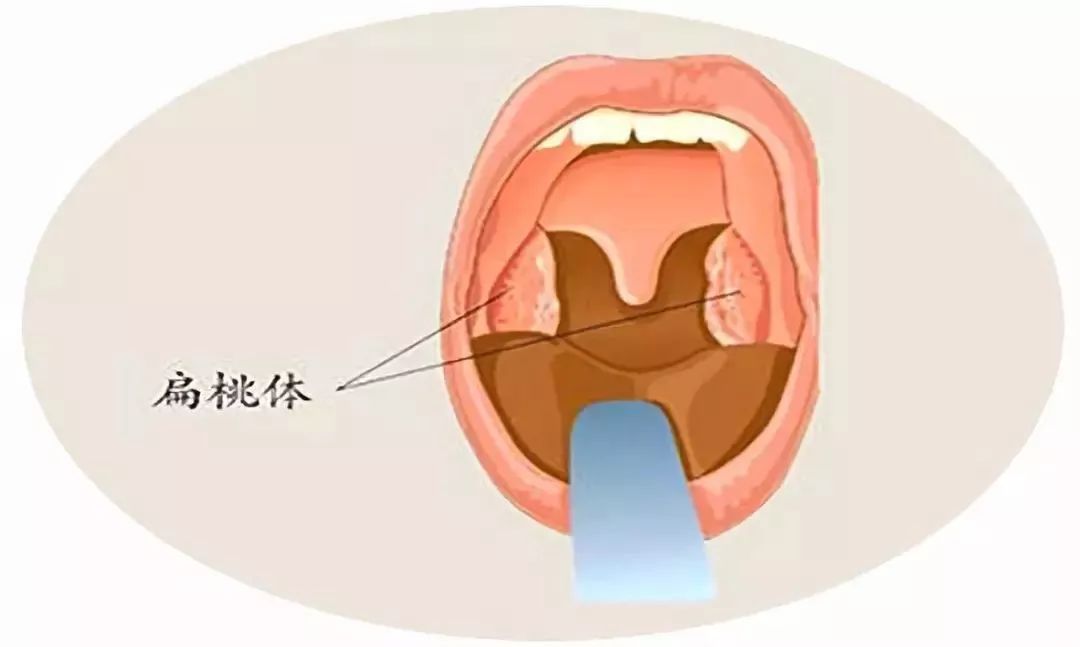 就會引起扁桃體發炎,從而導致紅腫疼痛以及化膿