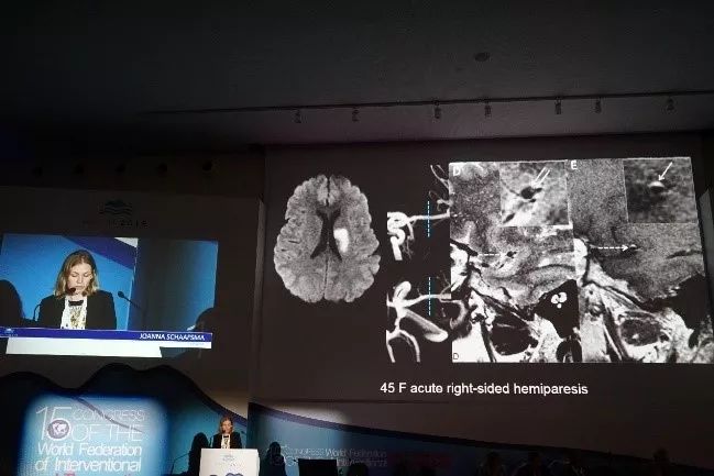 快讯wfitn2019在那不勒斯召开首日聚焦急性缺血卒中