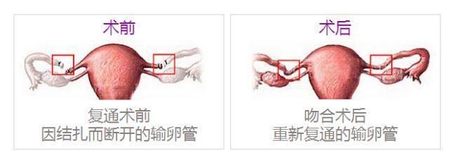 輸卵管結紮好幾年了,做復通手術懷孕幾率高嗎?