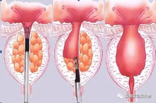 轻者尿频尿急,一般采用药物治疗;重者排尿困难,尿潴留,需要手术治疗