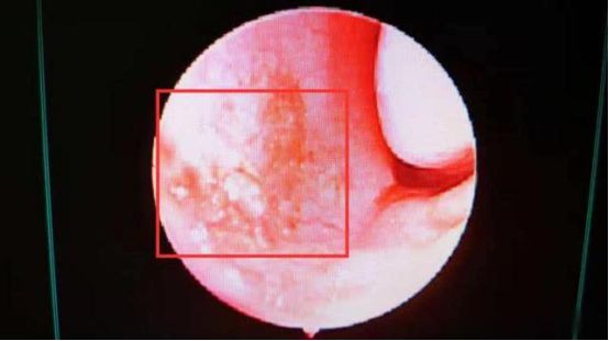 到达医院医生给孩子详细检查后,发现孩子的鼻黏膜干燥,双侧鼻中隔糜烂