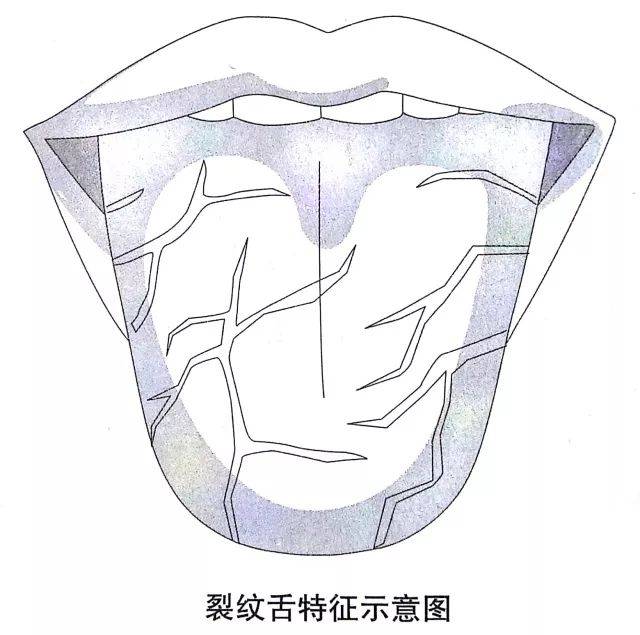 舌中有裂缝是什么原因?_裂纹