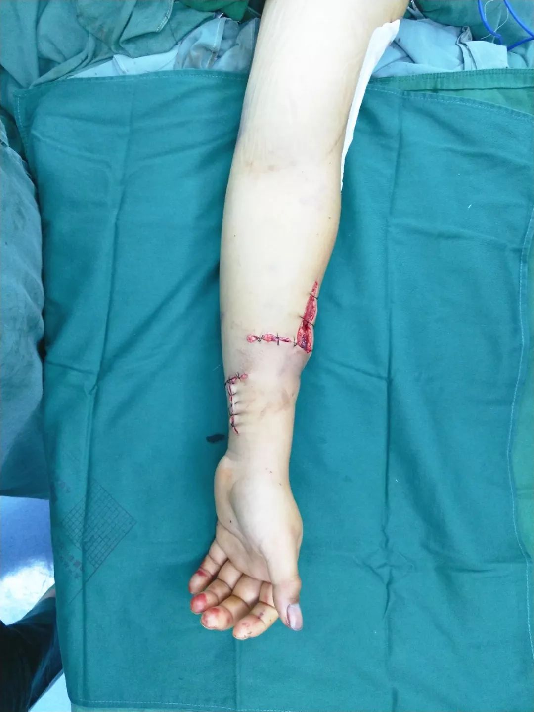 8小时接活断臂!广华这群医生是怎么做到的