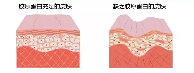 胶原蛋白充足的真皮层可以帮助皮肤抑制皱纹,保湿,减少色素沉着,使