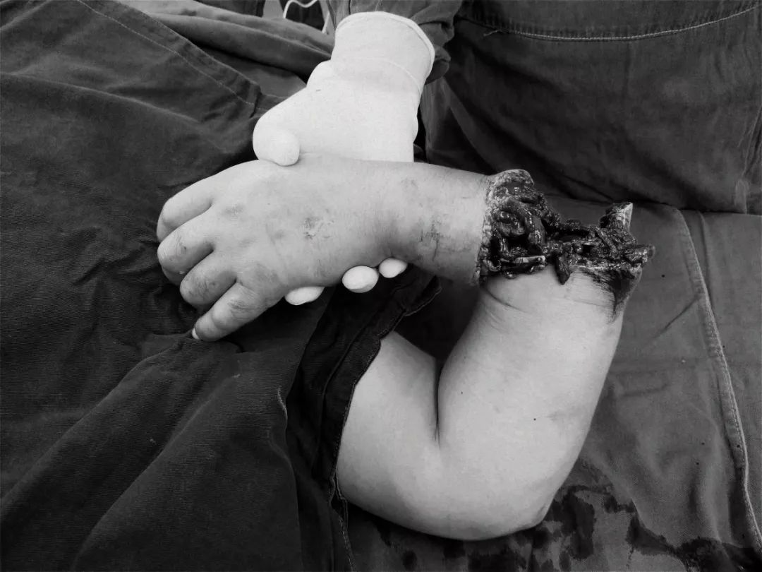 8小时接活断臂!广华这群医生是怎么做到的