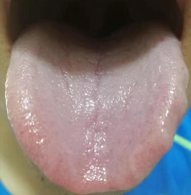 如何看舌苔血虚不润脾虚湿浸素体阴虚均可致舌苔出现裂纹