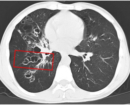 空洞和空腔病变傻傻分不清一文帮你搞定