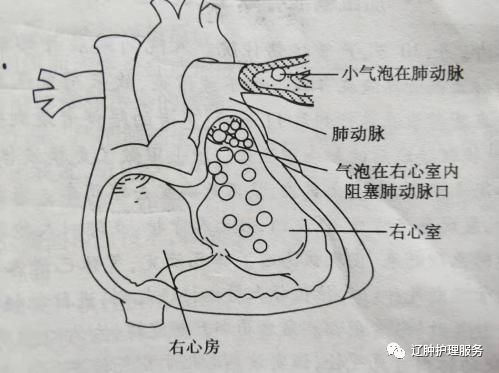 输液空气栓塞图片