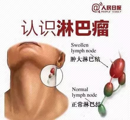 治愈之路你我同行正确认识淋巴瘤