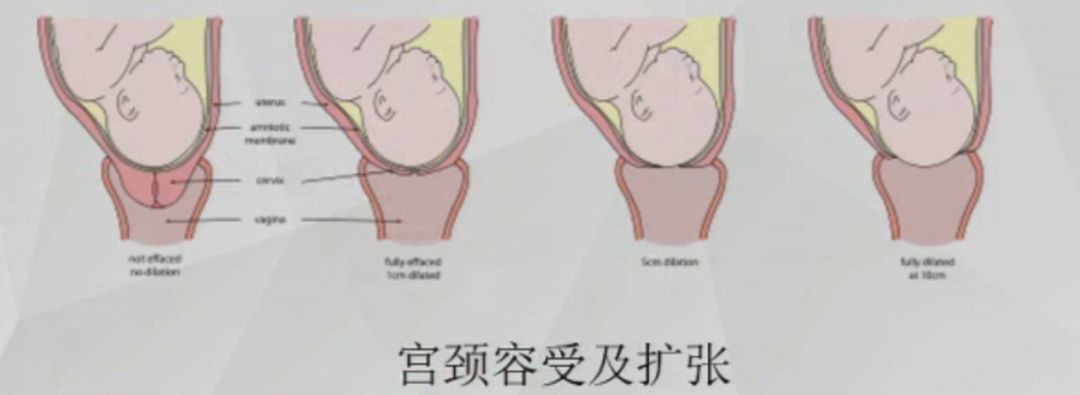 恐懼疼痛等 臨產 臨產:有規律且逐漸增強的子宮收縮,同時伴隨宮頸管