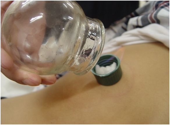 关于拔罐你不可不知的常识