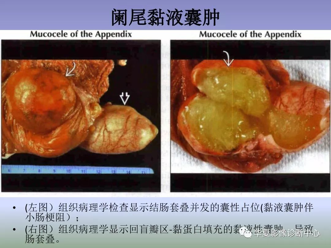 回盲部占位或炎症的影像鉴别诊断