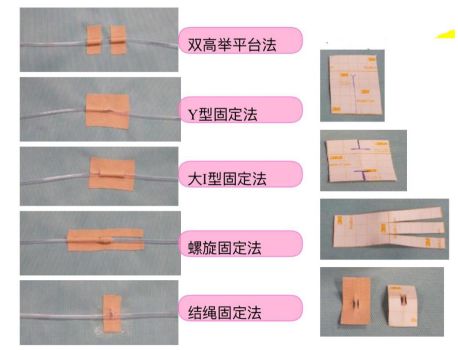 工字形胶布固定图片图片