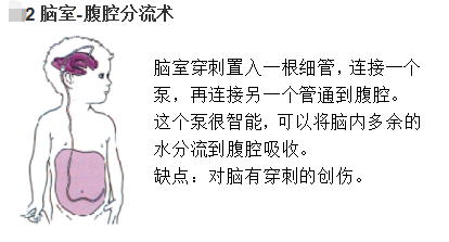2. 脑室—腹腔分流术