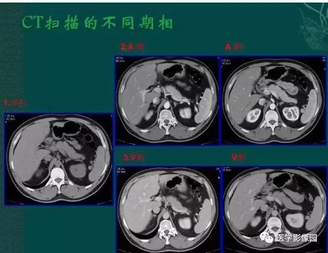 胰腺ct片子图解图片