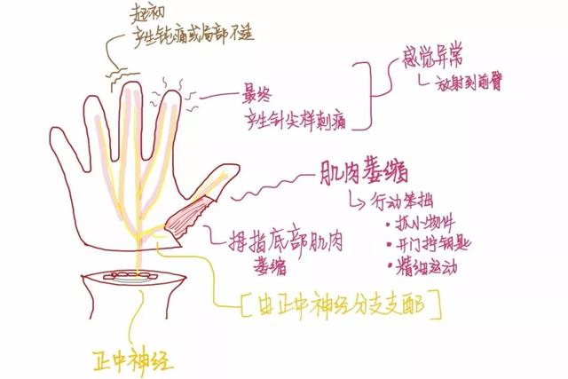 总而言之,只要是正中神经延伸的分支受到卡压,其支配的组织结构就会