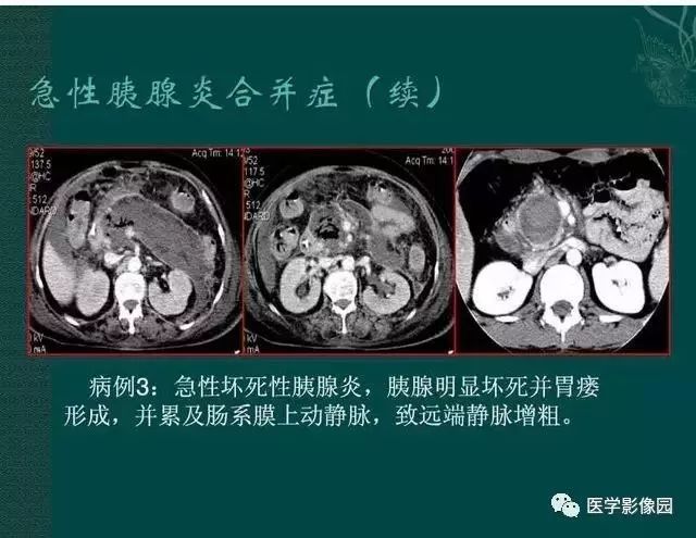 急性胰腺炎ct评价