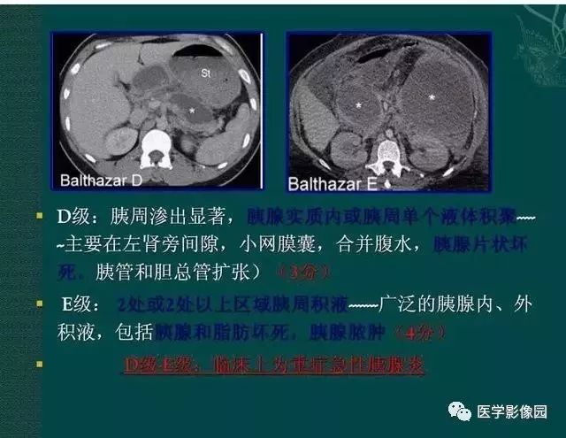 胰腺炎ct图片图解图片