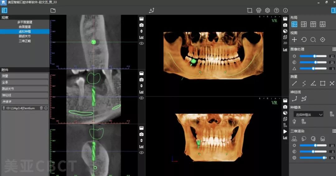 高可靠更聪明的口腔cbct来了