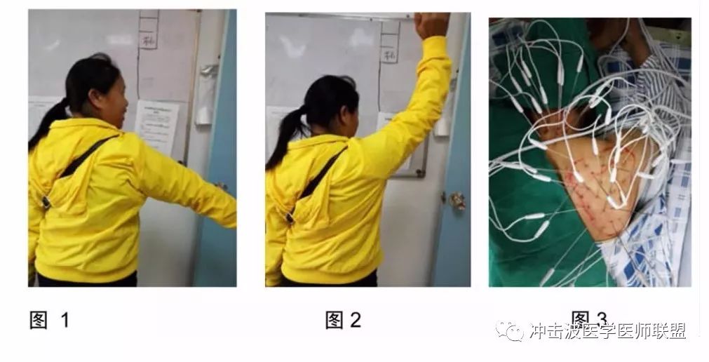 无痛性肩关节松解术配合内热针治疗冻结肩