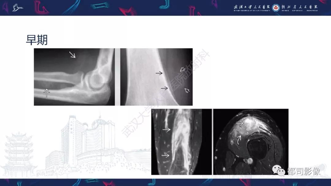 骨旁骨肉瘤影像诊断
