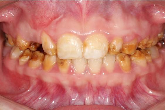 儿童牙釉质发育不全图图片