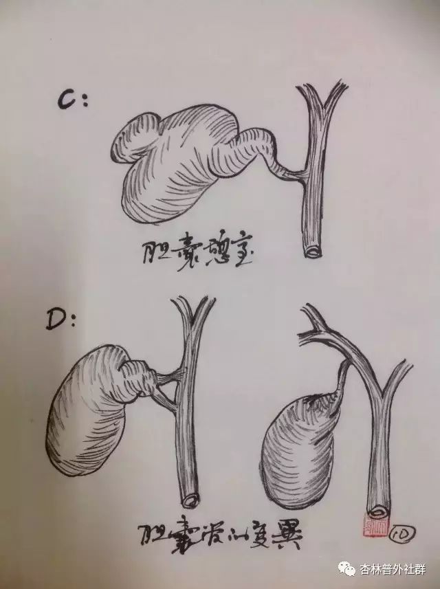 同学们预习时间到了专业手绘胆囊解剖美不美