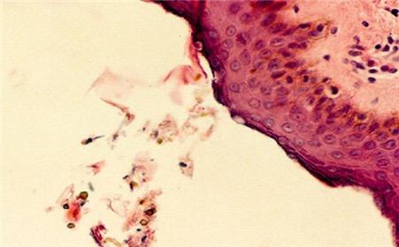 卵圆形糠秕孢子菌图片