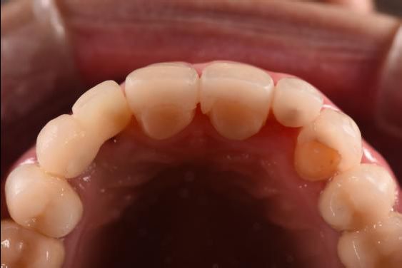 釉质发育不全的咬合重建一例2019escd认证病例