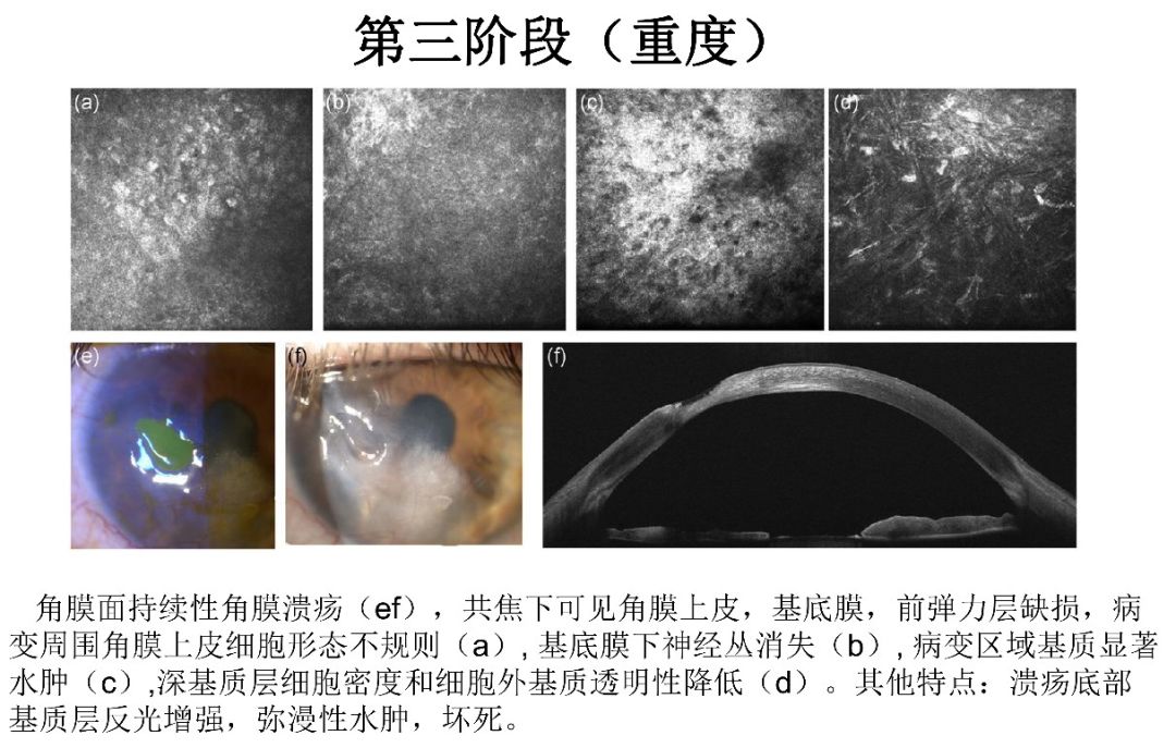 ccos角膜丨陈百华教授术后角膜病变的共焦显微镜特点与治疗策略