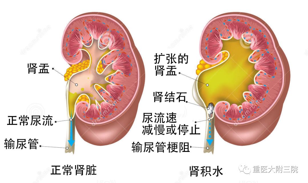 会造成肾脏排尿受阻,肾脏血流减少,继而发生肾小管变性,坏死,肾萎缩变