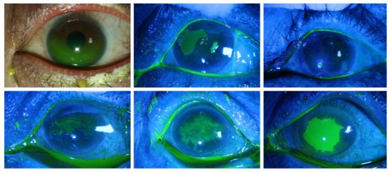 ccos角膜丨陈百华教授术后角膜病变的共焦显微镜特点与治疗策略
