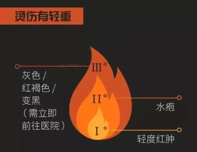 3個不要,5個步驟,輕鬆應付燙傷不慌張