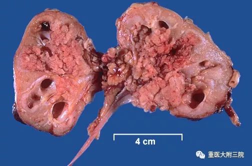 有一定癌变的几率,尤其是膀胱结石,肾盂结石,当然这个几率非常小