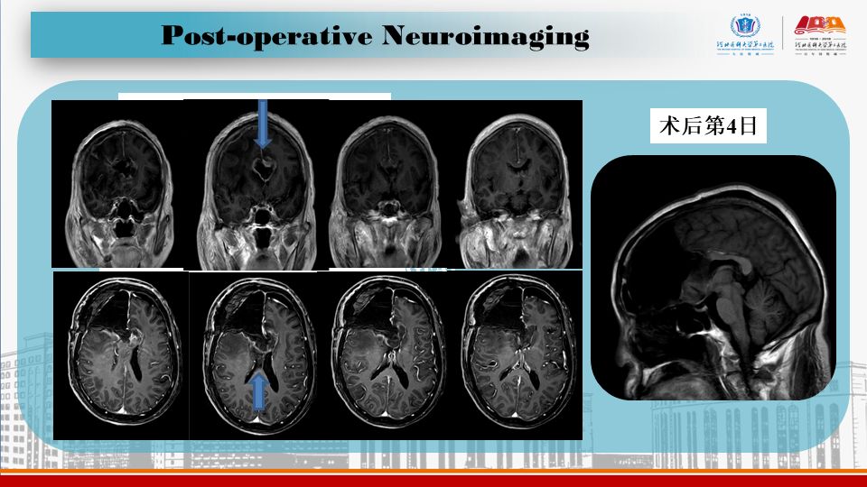 ppt| 累及胼胝体的脑胶质瘤手术切除 - 杨建凯 吕中强 孙国柱 宋剑