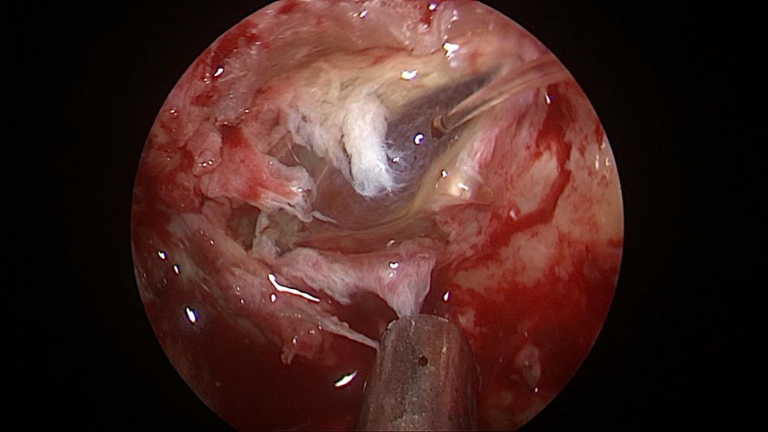 释放枕大池脑脊液完全打开枕大池暴露延髓,双侧扁桃体,小脑蚓下缘清除