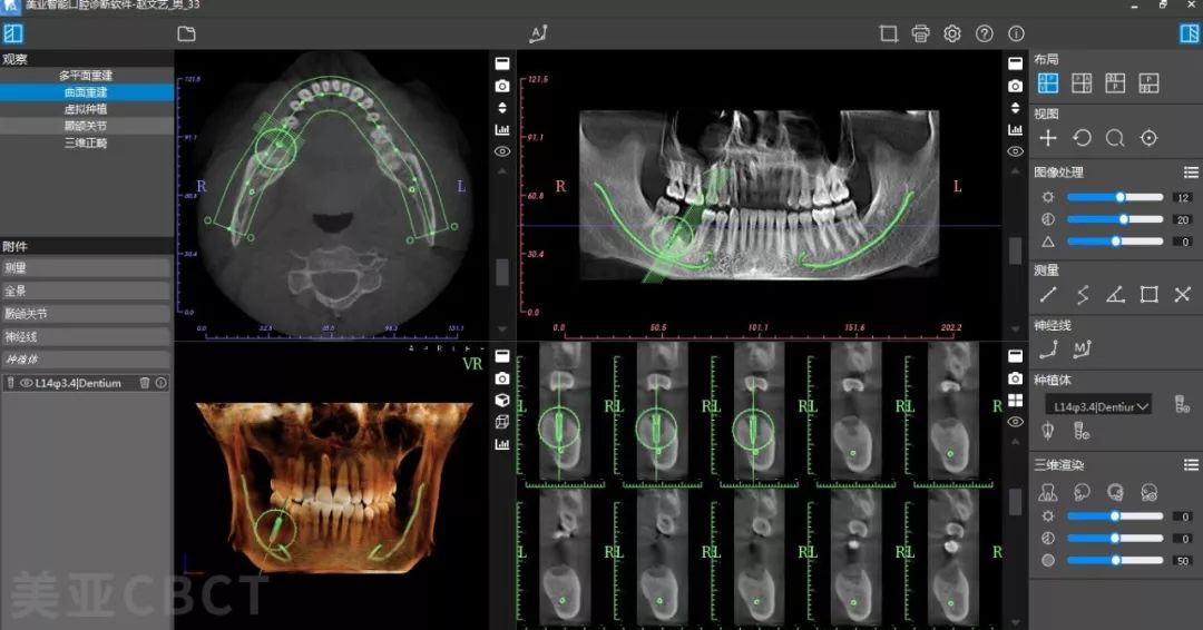 等功能,可实现模拟种植,自动神经管标注,自动骨密度分析,自动定位tmj