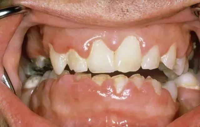 年纪轻轻的就"老掉牙"?这可咋整,千万别这样