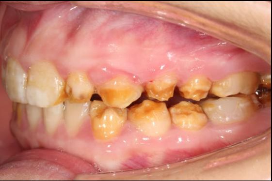 釉质发育不全图片图片