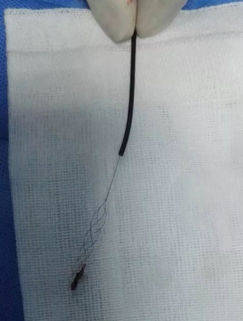 使用8f指引导管,5f navien导管作为中间导管,synchro微导丝;取栓过程